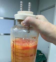 达州水动力吸脂手术要做多久？